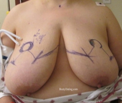 Busty Breast Reductions - Set 26 - N